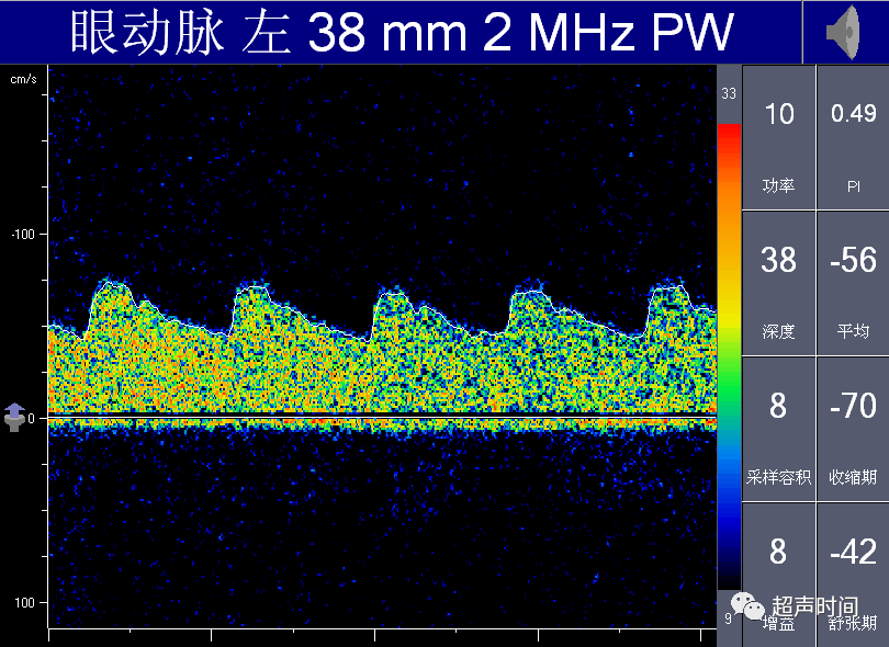 TCD怎么切换探头【血管超声】经颅多普勒（TCD）基础知识及临床应用_https://www.jmylbn.com_新闻资讯_第44张