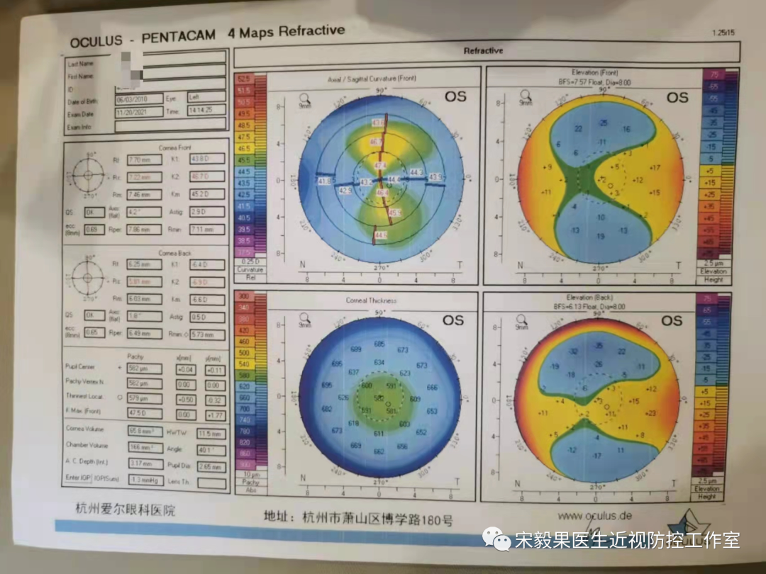 为什么电脑的打mmhg10近视防控直播13--弱视治愈后近视怎么办--近视疯狂在进展，经过治疗得到了控制_https://www.jmylbn.com_新闻资讯_第7张