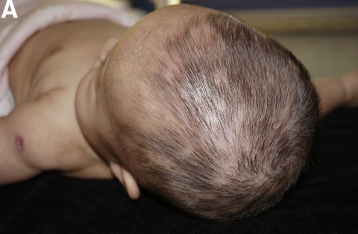 有奖病例竞猜第208期丨4个月小婴儿大面积斑秃，难道也是因为生活压力太大？