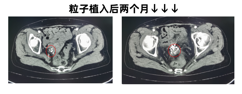宫颈癌2.png
