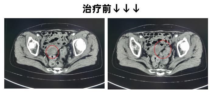 宫颈癌1.png