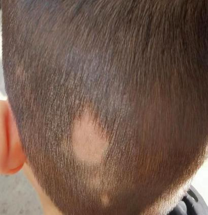 三岁半儿童头发突然秃了一小块，这可怎么办？去医院挂什么科