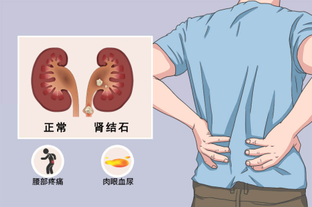 结石liying战石记反复肾结石伴尿结晶患者加强补充维生素d和钙剂后