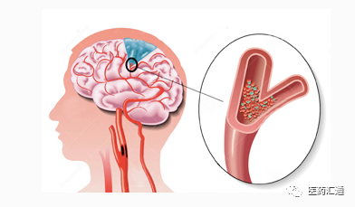 急性腦血管疾病的預防措施有哪些？ 健康 第2張