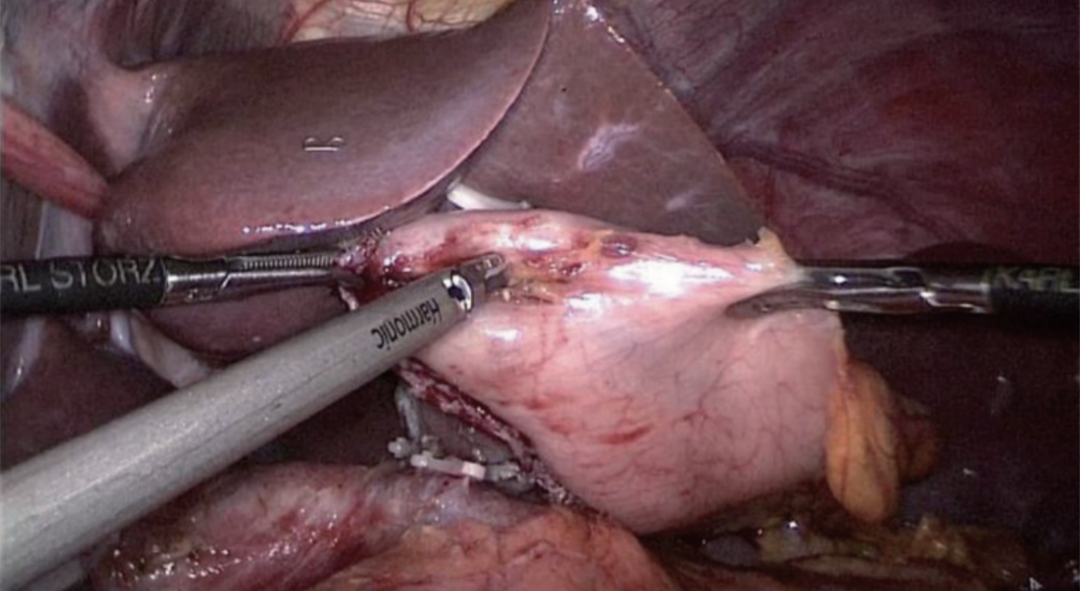 肠道吻合器是什么材质尤俊等人：术后消化道重建之Overlap、FETE、Billroth+Braun吻合｜《腹腔镜胃肠手术笔记（第二版）》新书抢先看_https://www.jmylbn.com_新闻资讯_第29张