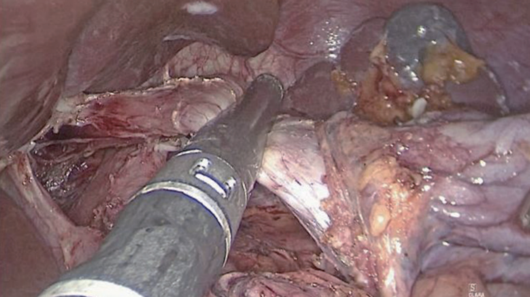 肠道吻合器是什么材质尤俊等人：术后消化道重建之Overlap、FETE、Billroth+Braun吻合｜《腹腔镜胃肠手术笔记（第二版）》新书抢先看_https://www.jmylbn.com_新闻资讯_第7张