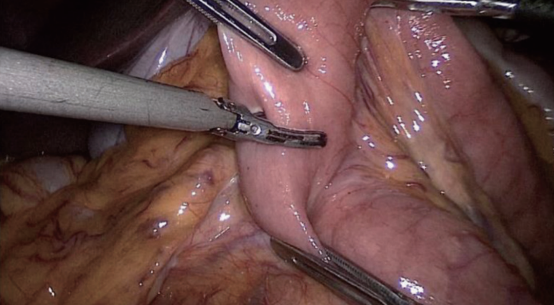 肠道吻合器是什么材质尤俊等人：术后消化道重建之Overlap、FETE、Billroth+Braun吻合｜《腹腔镜胃肠手术笔记（第二版）》新书抢先看_https://www.jmylbn.com_新闻资讯_第32张