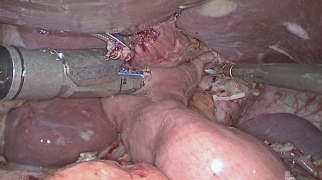 肠道吻合器是什么材质尤俊等人：术后消化道重建之Overlap、FETE、Billroth+Braun吻合｜《腹腔镜胃肠手术笔记（第二版）》新书抢先看_https://www.jmylbn.com_新闻资讯_第13张