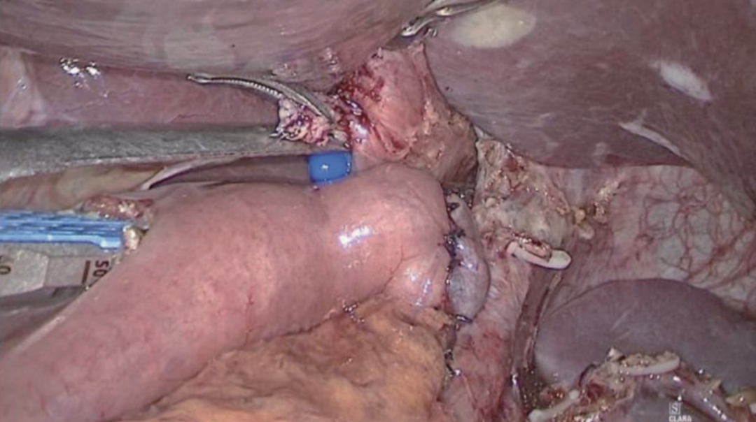 肠道吻合器是什么材质尤俊等人：术后消化道重建之Overlap、FETE、Billroth+Braun吻合｜《腹腔镜胃肠手术笔记（第二版）》新书抢先看_https://www.jmylbn.com_新闻资讯_第12张