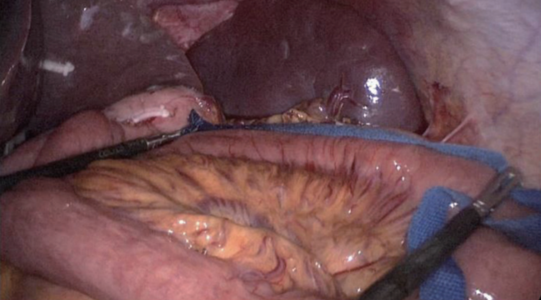 肠道吻合器是什么材质尤俊等人：术后消化道重建之Overlap、FETE、Billroth+Braun吻合｜《腹腔镜胃肠手术笔记（第二版）》新书抢先看_https://www.jmylbn.com_新闻资讯_第41张