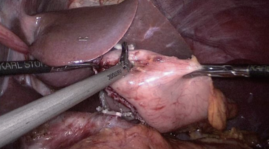 肠道吻合器是什么材质尤俊等人：术后消化道重建之Overlap、FETE、Billroth+Braun吻合｜《腹腔镜胃肠手术笔记（第二版）》新书抢先看_https://www.jmylbn.com_新闻资讯_第28张