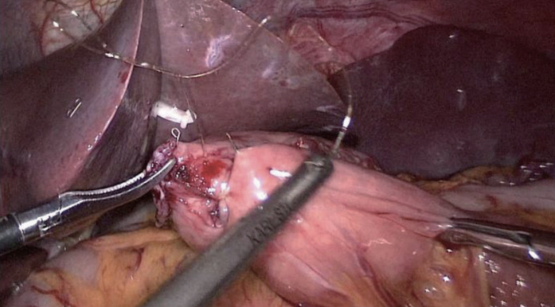 肠道吻合器是什么材质尤俊等人：术后消化道重建之Overlap、FETE、Billroth+Braun吻合｜《腹腔镜胃肠手术笔记（第二版）》新书抢先看_https://www.jmylbn.com_新闻资讯_第38张