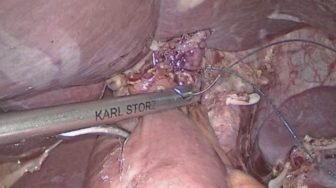 肠道吻合器是什么材质尤俊等人：术后消化道重建之Overlap、FETE、Billroth+Braun吻合｜《腹腔镜胃肠手术笔记（第二版）》新书抢先看_https://www.jmylbn.com_新闻资讯_第15张