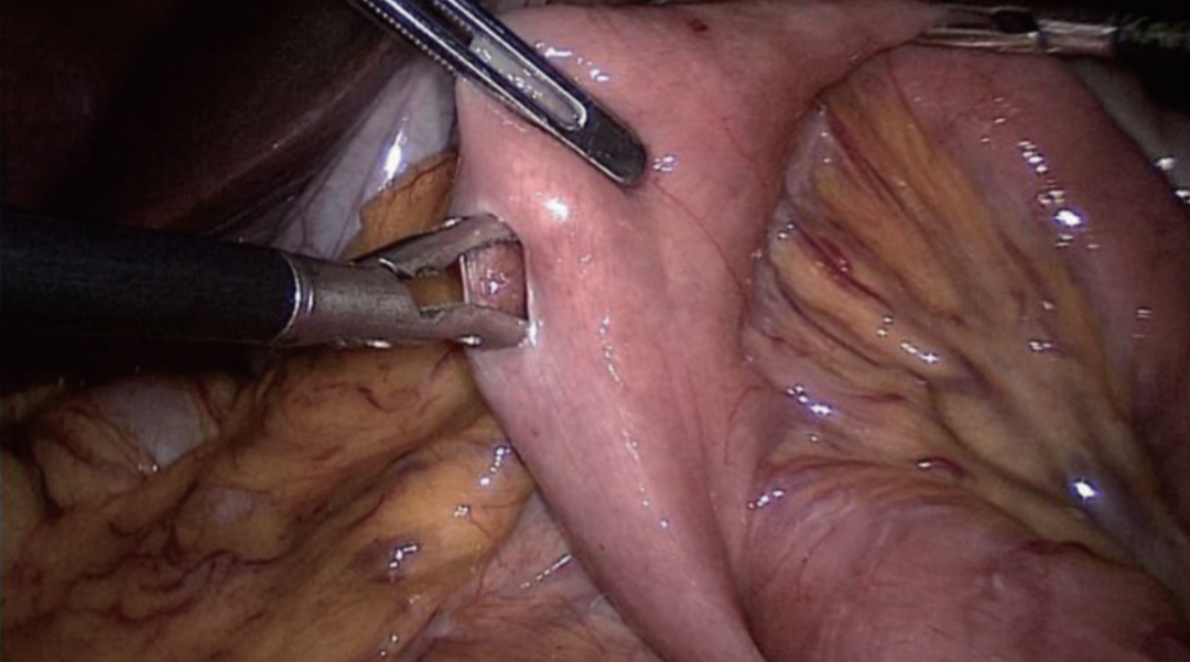 肠道吻合器是什么材质尤俊等人：术后消化道重建之Overlap、FETE、Billroth+Braun吻合｜《腹腔镜胃肠手术笔记（第二版）》新书抢先看_https://www.jmylbn.com_新闻资讯_第34张