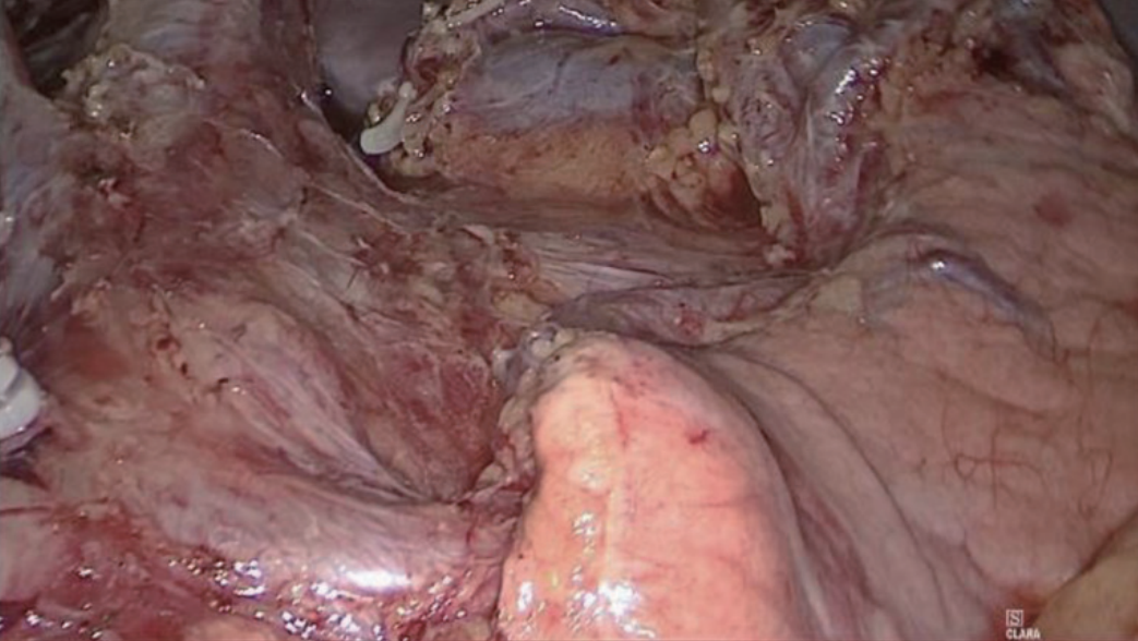 肠道吻合器是什么材质尤俊等人：术后消化道重建之Overlap、FETE、Billroth+Braun吻合｜《腹腔镜胃肠手术笔记（第二版）》新书抢先看_https://www.jmylbn.com_新闻资讯_第5张