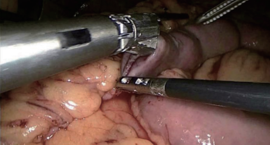 肠道吻合器是什么材质尤俊等人：术后消化道重建之Overlap、FETE、Billroth+Braun吻合｜《腹腔镜胃肠手术笔记（第二版）》新书抢先看_https://www.jmylbn.com_新闻资讯_第22张