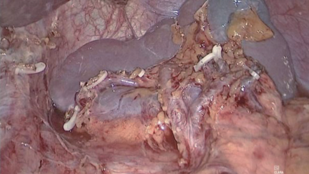 肠道吻合器是什么材质尤俊等人：术后消化道重建之Overlap、FETE、Billroth+Braun吻合｜《腹腔镜胃肠手术笔记（第二版）》新书抢先看_https://www.jmylbn.com_新闻资讯_第6张