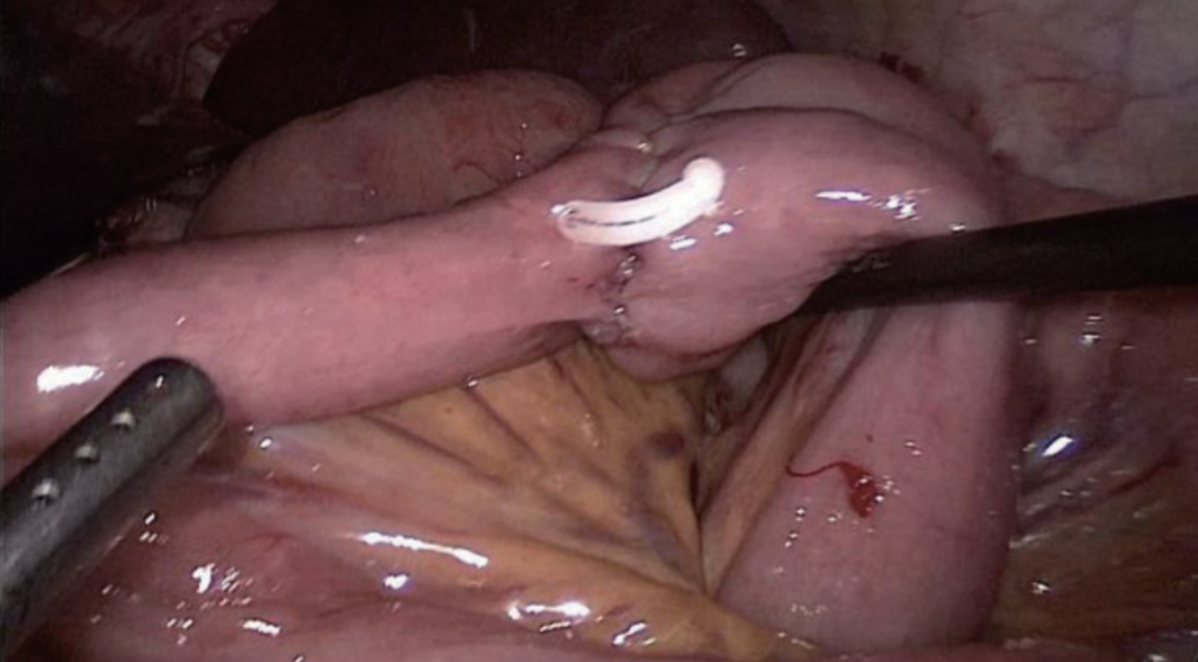 肠道吻合器是什么材质尤俊等人：术后消化道重建之Overlap、FETE、Billroth+Braun吻合｜《腹腔镜胃肠手术笔记（第二版）》新书抢先看_https://www.jmylbn.com_新闻资讯_第45张