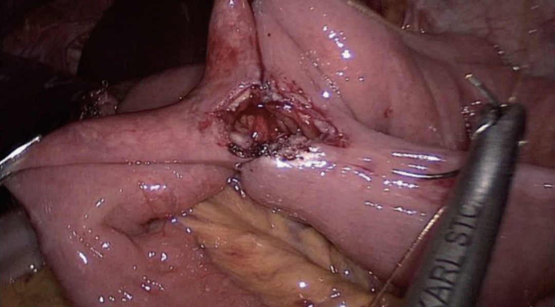 肠道吻合器是什么材质尤俊等人：术后消化道重建之Overlap、FETE、Billroth+Braun吻合｜《腹腔镜胃肠手术笔记（第二版）》新书抢先看_https://www.jmylbn.com_新闻资讯_第43张