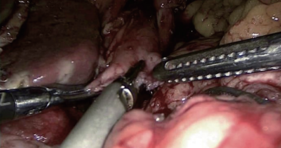 肠道吻合器是什么材质尤俊等人：术后消化道重建之Overlap、FETE、Billroth+Braun吻合｜《腹腔镜胃肠手术笔记（第二版）》新书抢先看_https://www.jmylbn.com_新闻资讯_第21张