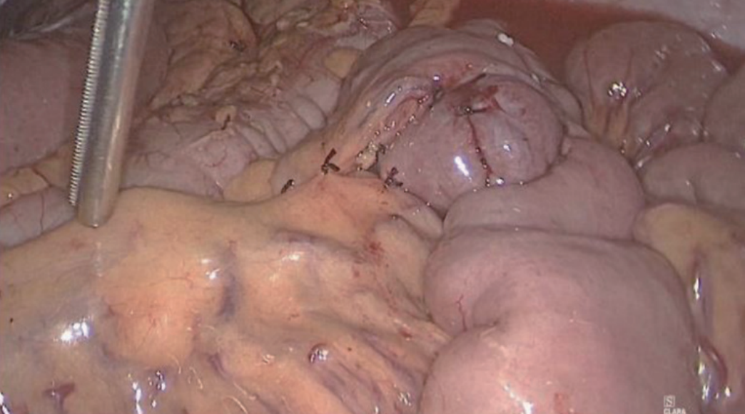 肠道吻合器是什么材质尤俊等人：术后消化道重建之Overlap、FETE、Billroth+Braun吻合｜《腹腔镜胃肠手术笔记（第二版）》新书抢先看_https://www.jmylbn.com_新闻资讯_第8张