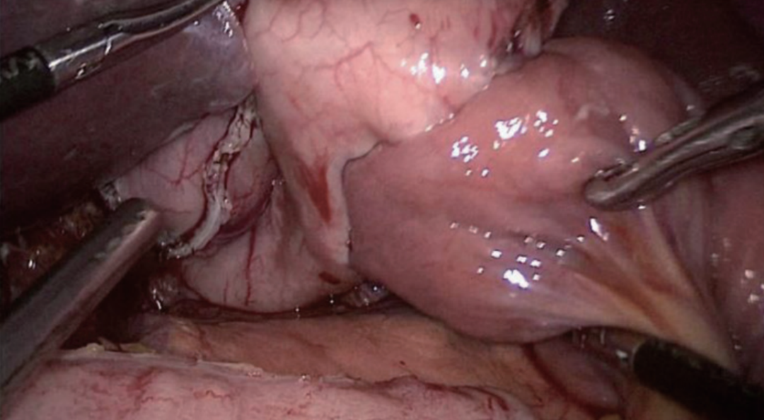 肠道吻合器是什么材质尤俊等人：术后消化道重建之Overlap、FETE、Billroth+Braun吻合｜《腹腔镜胃肠手术笔记（第二版）》新书抢先看_https://www.jmylbn.com_新闻资讯_第40张