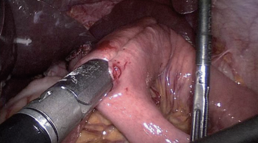 肠道吻合器是什么材质尤俊等人：术后消化道重建之Overlap、FETE、Billroth+Braun吻合｜《腹腔镜胃肠手术笔记（第二版）》新书抢先看_https://www.jmylbn.com_新闻资讯_第42张