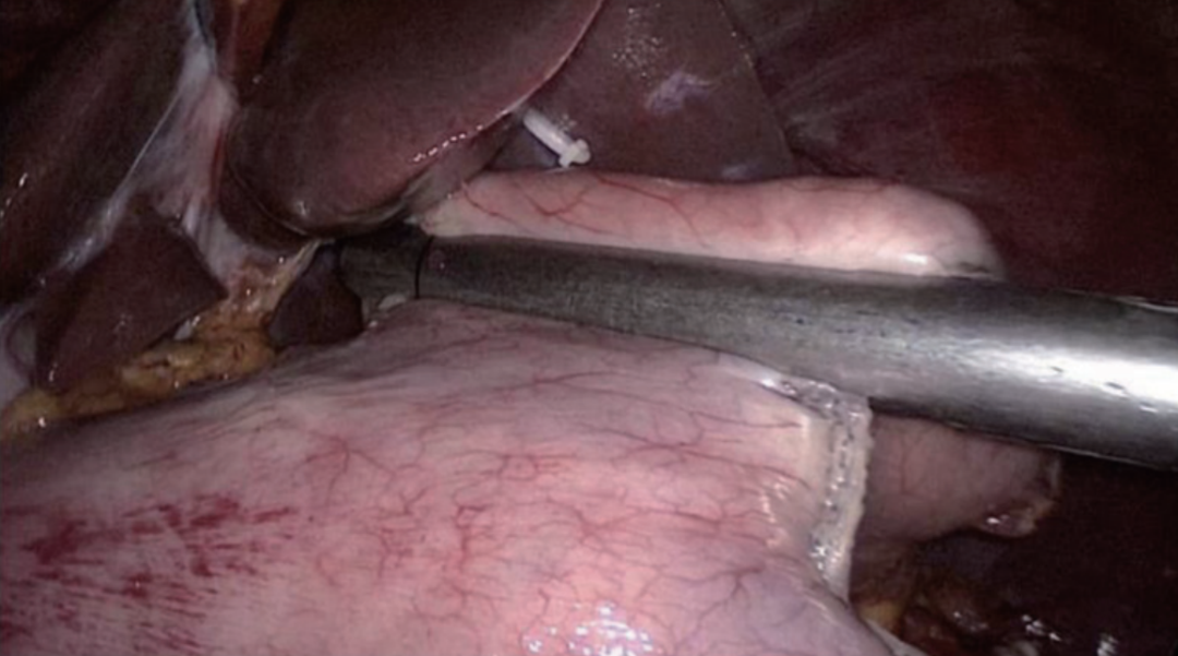 肠道吻合器是什么材质尤俊等人：术后消化道重建之Overlap、FETE、Billroth+Braun吻合｜《腹腔镜胃肠手术笔记（第二版）》新书抢先看_https://www.jmylbn.com_新闻资讯_第27张