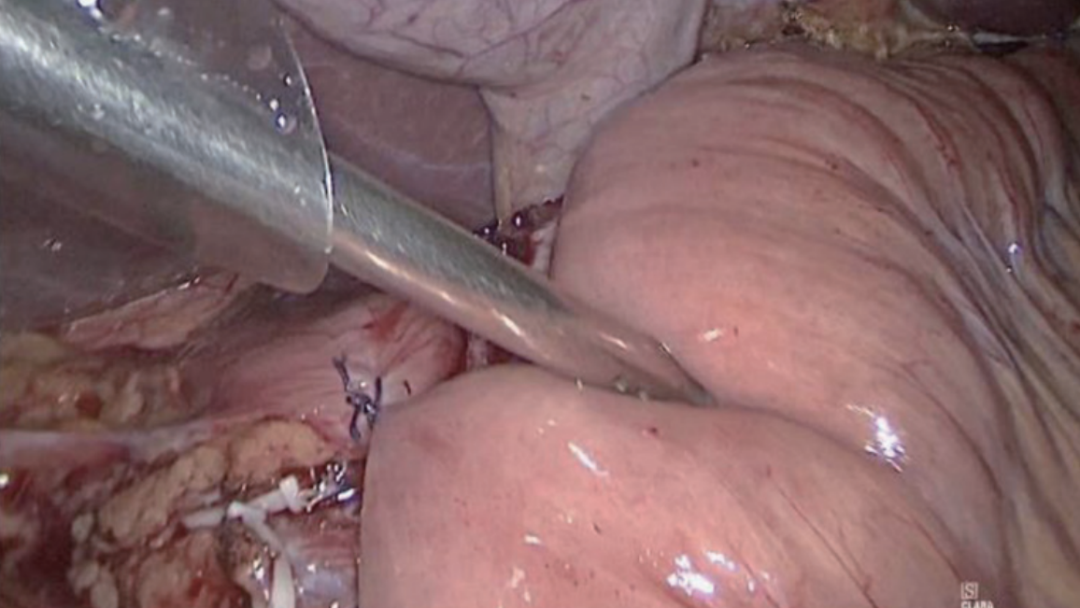 肠道吻合器是什么材质尤俊等人：术后消化道重建之Overlap、FETE、Billroth+Braun吻合｜《腹腔镜胃肠手术笔记（第二版）》新书抢先看_https://www.jmylbn.com_新闻资讯_第20张