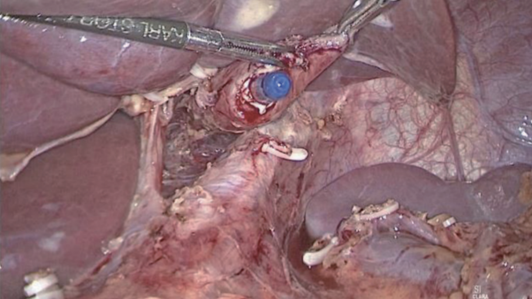 肠道吻合器是什么材质尤俊等人：术后消化道重建之Overlap、FETE、Billroth+Braun吻合｜《腹腔镜胃肠手术笔记（第二版）》新书抢先看_https://www.jmylbn.com_新闻资讯_第10张