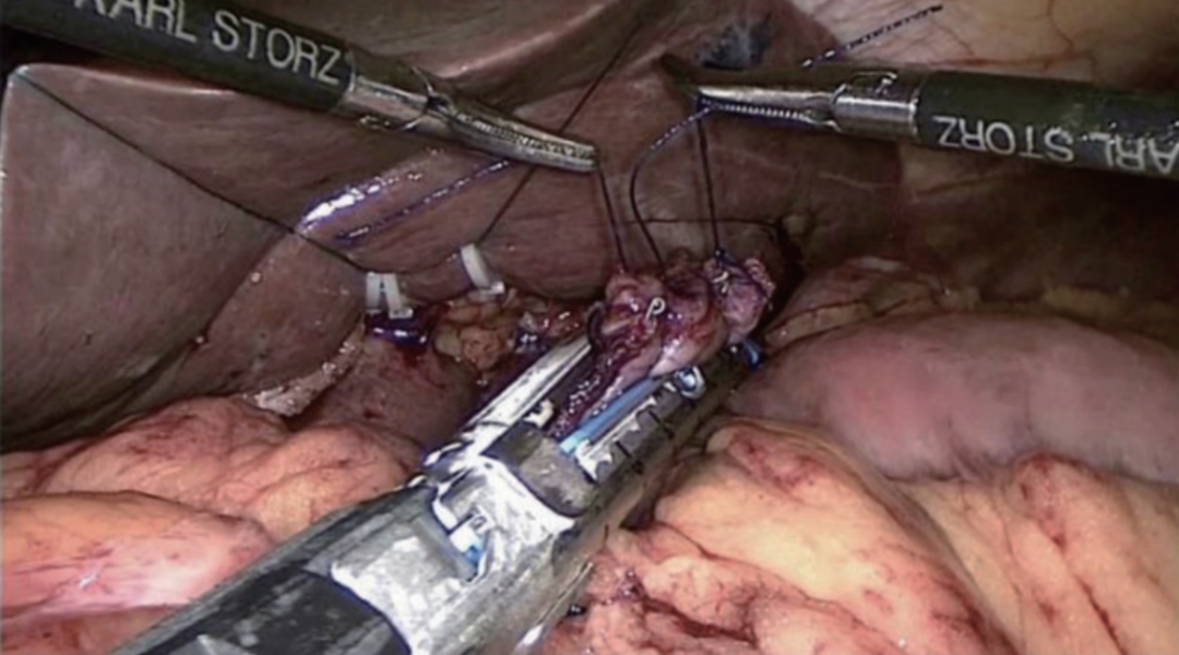 肠道吻合器是什么材质尤俊等人：术后消化道重建之Overlap、FETE、Billroth+Braun吻合｜《腹腔镜胃肠手术笔记（第二版）》新书抢先看_https://www.jmylbn.com_新闻资讯_第24张