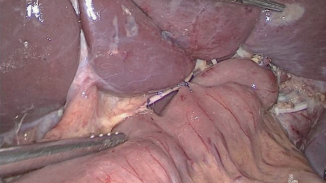 肠道吻合器是什么材质尤俊等人：术后消化道重建之Overlap、FETE、Billroth+Braun吻合｜《腹腔镜胃肠手术笔记（第二版）》新书抢先看_https://www.jmylbn.com_新闻资讯_第19张