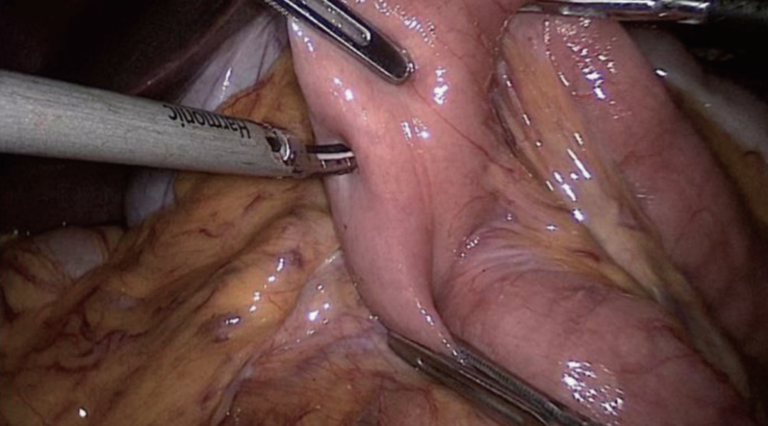 肠道吻合器是什么材质尤俊等人：术后消化道重建之Overlap、FETE、Billroth+Braun吻合｜《腹腔镜胃肠手术笔记（第二版）》新书抢先看_https://www.jmylbn.com_新闻资讯_第33张