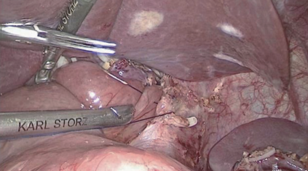 肠道吻合器是什么材质尤俊等人：术后消化道重建之Overlap、FETE、Billroth+Braun吻合｜《腹腔镜胃肠手术笔记（第二版）》新书抢先看_https://www.jmylbn.com_新闻资讯_第17张