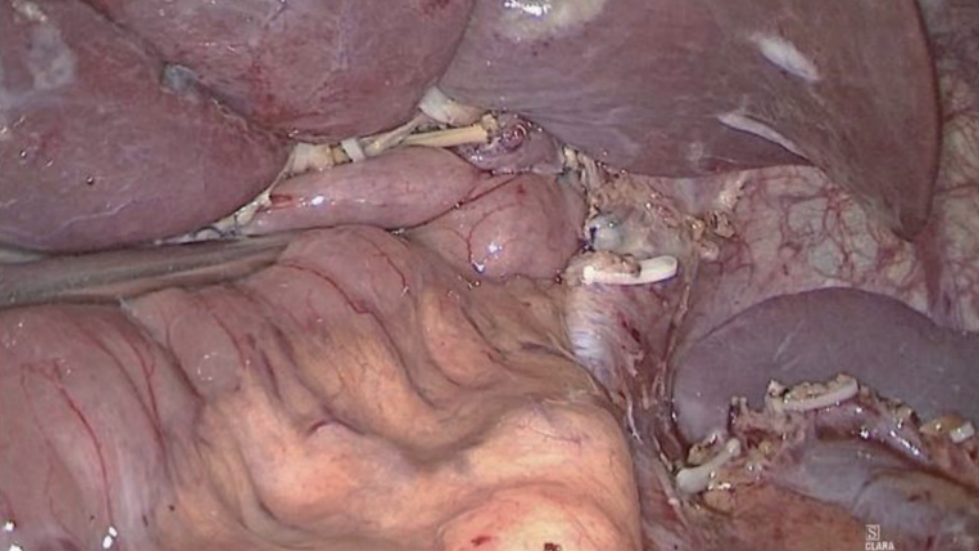 肠道吻合器是什么材质尤俊等人：术后消化道重建之Overlap、FETE、Billroth+Braun吻合｜《腹腔镜胃肠手术笔记（第二版）》新书抢先看_https://www.jmylbn.com_新闻资讯_第18张