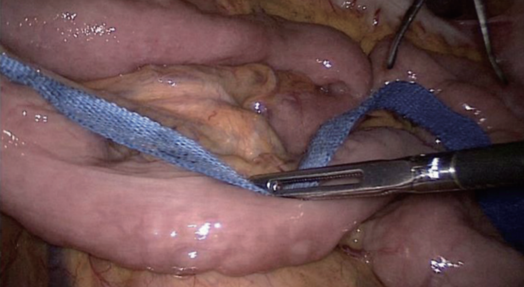 肠道吻合器是什么材质尤俊等人：术后消化道重建之Overlap、FETE、Billroth+Braun吻合｜《腹腔镜胃肠手术笔记（第二版）》新书抢先看_https://www.jmylbn.com_新闻资讯_第31张