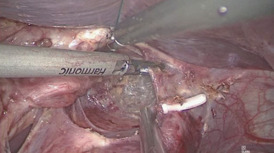 肠道吻合器是什么材质尤俊等人：术后消化道重建之Overlap、FETE、Billroth+Braun吻合｜《腹腔镜胃肠手术笔记（第二版）》新书抢先看_https://www.jmylbn.com_新闻资讯_第2张