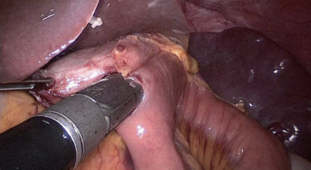 肠道吻合器是什么材质尤俊等人：术后消化道重建之Overlap、FETE、Billroth+Braun吻合｜《腹腔镜胃肠手术笔记（第二版）》新书抢先看_https://www.jmylbn.com_新闻资讯_第36张