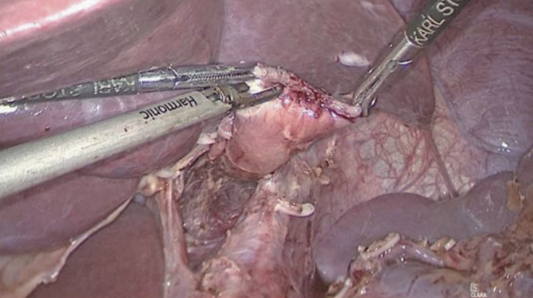 肠道吻合器是什么材质尤俊等人：术后消化道重建之Overlap、FETE、Billroth+Braun吻合｜《腹腔镜胃肠手术笔记（第二版）》新书抢先看_https://www.jmylbn.com_新闻资讯_第9张