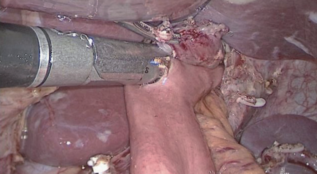 肠道吻合器是什么材质尤俊等人：术后消化道重建之Overlap、FETE、Billroth+Braun吻合｜《腹腔镜胃肠手术笔记（第二版）》新书抢先看_https://www.jmylbn.com_新闻资讯_第14张