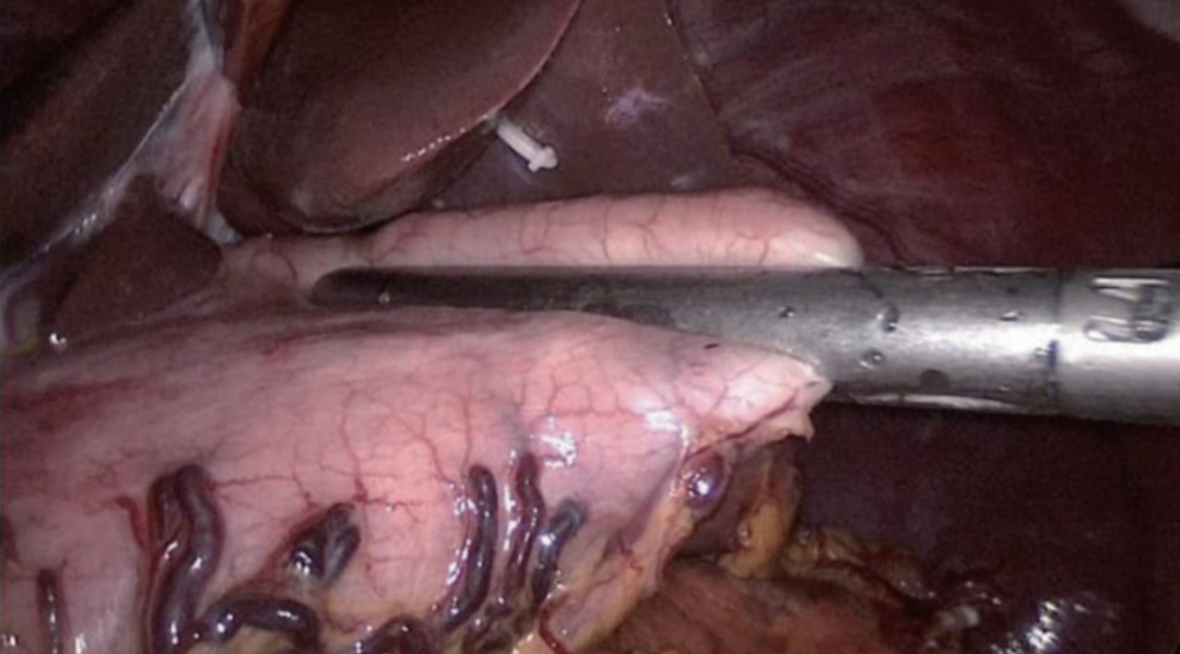 肠道吻合器是什么材质尤俊等人：术后消化道重建之Overlap、FETE、Billroth+Braun吻合｜《腹腔镜胃肠手术笔记（第二版）》新书抢先看_https://www.jmylbn.com_新闻资讯_第26张