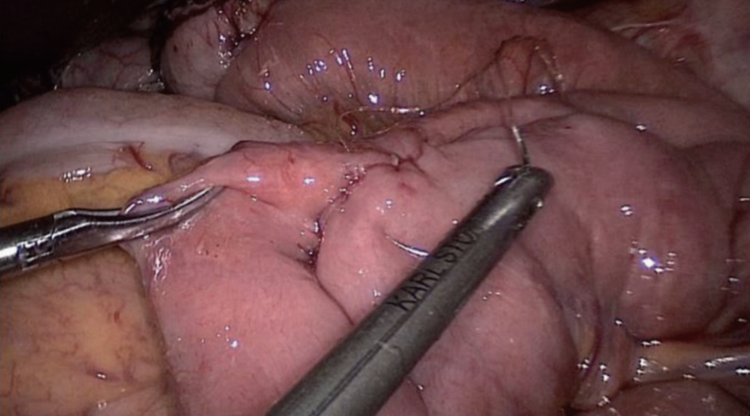 肠道吻合器是什么材质尤俊等人：术后消化道重建之Overlap、FETE、Billroth+Braun吻合｜《腹腔镜胃肠手术笔记（第二版）》新书抢先看_https://www.jmylbn.com_新闻资讯_第44张