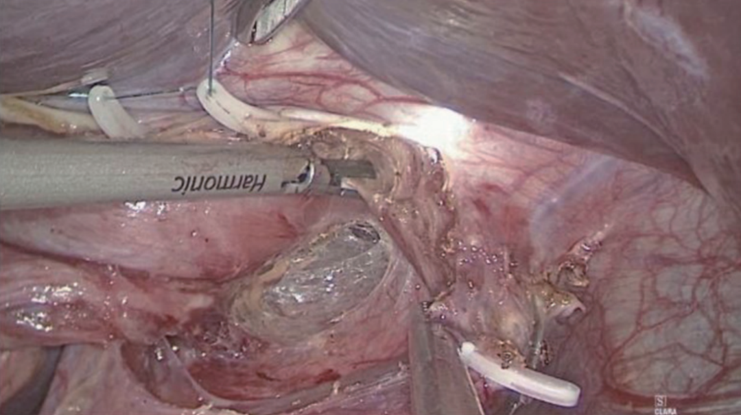 肠道吻合器是什么材质尤俊等人：术后消化道重建之Overlap、FETE、Billroth+Braun吻合｜《腹腔镜胃肠手术笔记（第二版）》新书抢先看_https://www.jmylbn.com_新闻资讯_第3张