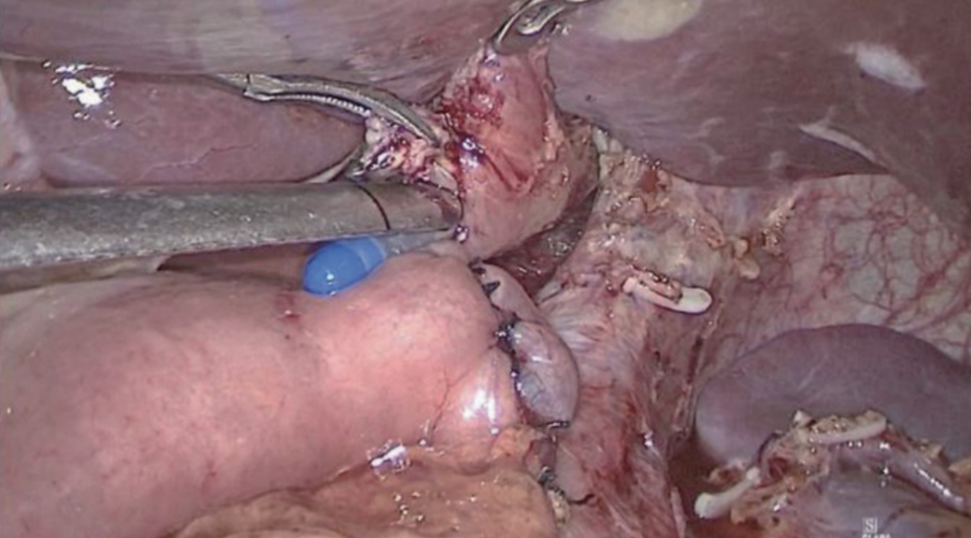 肠道吻合器是什么材质尤俊等人：术后消化道重建之Overlap、FETE、Billroth+Braun吻合｜《腹腔镜胃肠手术笔记（第二版）》新书抢先看_https://www.jmylbn.com_新闻资讯_第11张