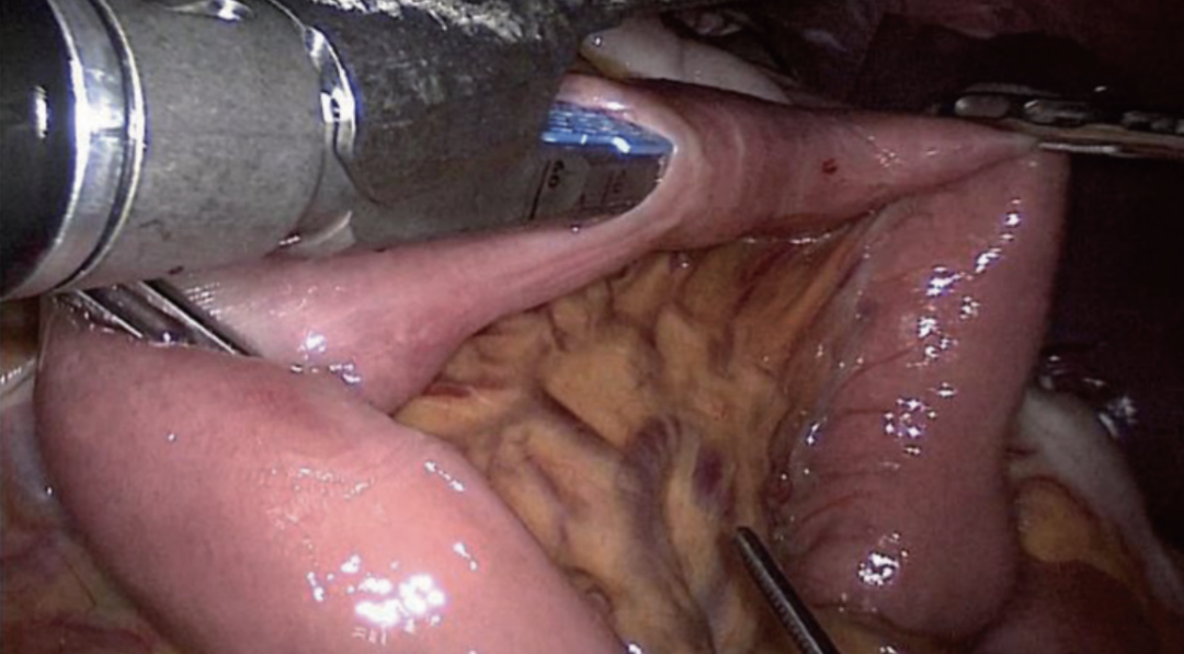 肠道吻合器是什么材质尤俊等人：术后消化道重建之Overlap、FETE、Billroth+Braun吻合｜《腹腔镜胃肠手术笔记（第二版）》新书抢先看_https://www.jmylbn.com_新闻资讯_第35张