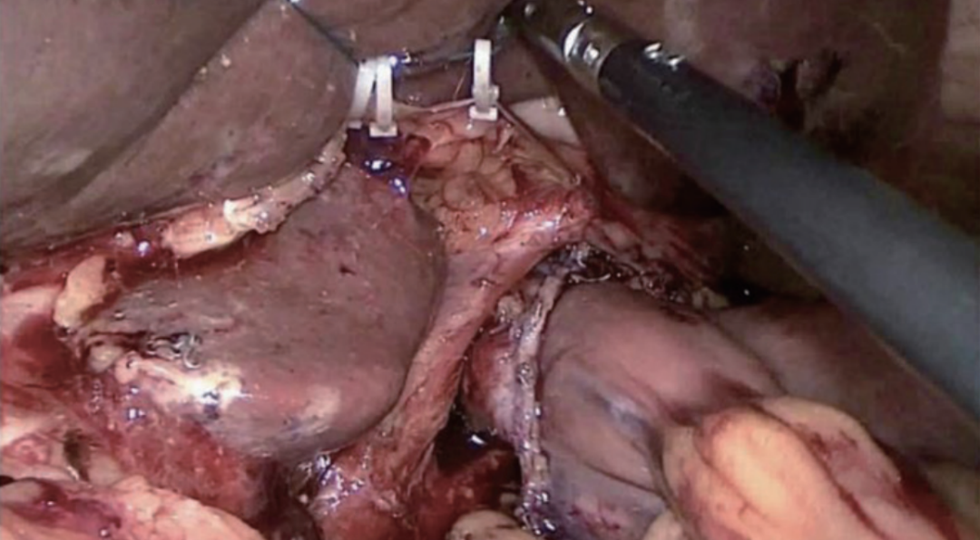 肠道吻合器是什么材质尤俊等人：术后消化道重建之Overlap、FETE、Billroth+Braun吻合｜《腹腔镜胃肠手术笔记（第二版）》新书抢先看_https://www.jmylbn.com_新闻资讯_第25张