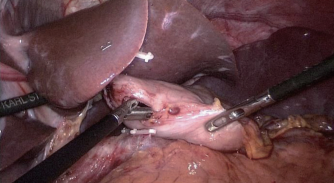 肠道吻合器是什么材质尤俊等人：术后消化道重建之Overlap、FETE、Billroth+Braun吻合｜《腹腔镜胃肠手术笔记（第二版）》新书抢先看_https://www.jmylbn.com_新闻资讯_第30张