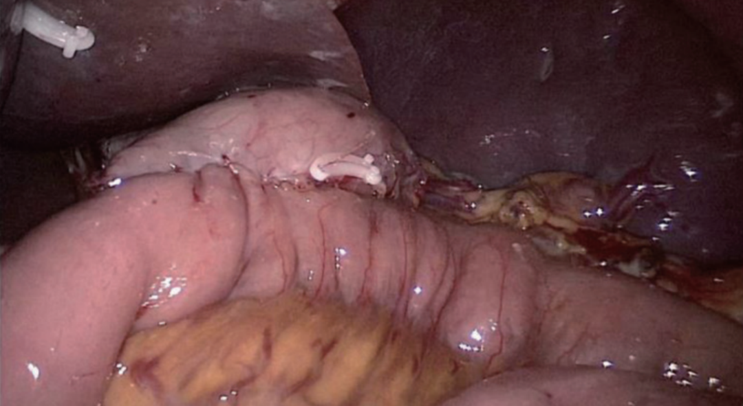 肠道吻合器是什么材质尤俊等人：术后消化道重建之Overlap、FETE、Billroth+Braun吻合｜《腹腔镜胃肠手术笔记（第二版）》新书抢先看_https://www.jmylbn.com_新闻资讯_第39张