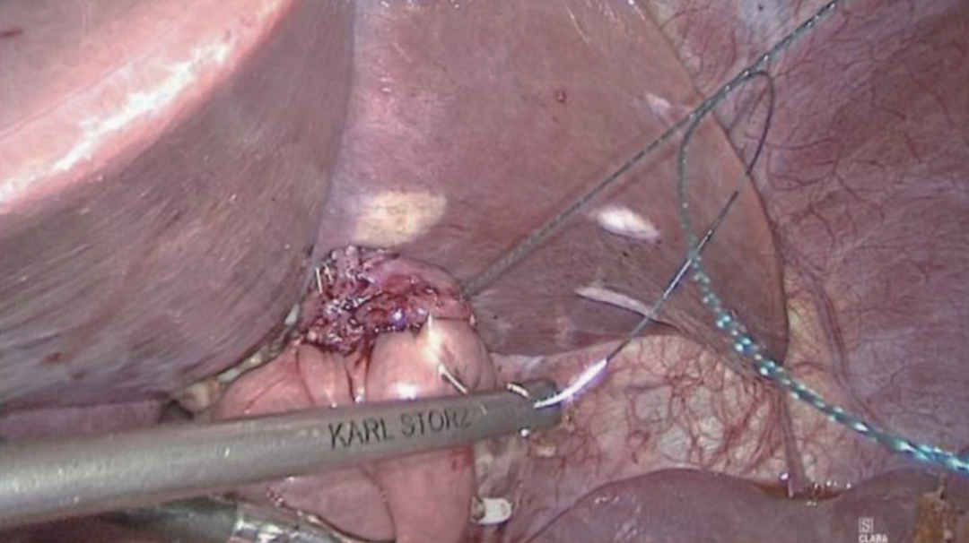 肠道吻合器是什么材质尤俊等人：术后消化道重建之Overlap、FETE、Billroth+Braun吻合｜《腹腔镜胃肠手术笔记（第二版）》新书抢先看_https://www.jmylbn.com_新闻资讯_第16张