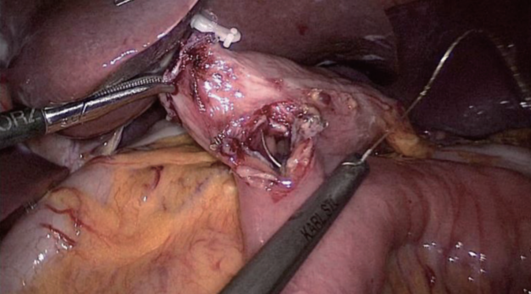 肠道吻合器是什么材质尤俊等人：术后消化道重建之Overlap、FETE、Billroth+Braun吻合｜《腹腔镜胃肠手术笔记（第二版）》新书抢先看_https://www.jmylbn.com_新闻资讯_第37张